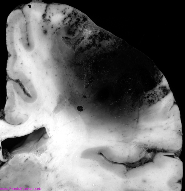 Venous infarct, frontal lobe